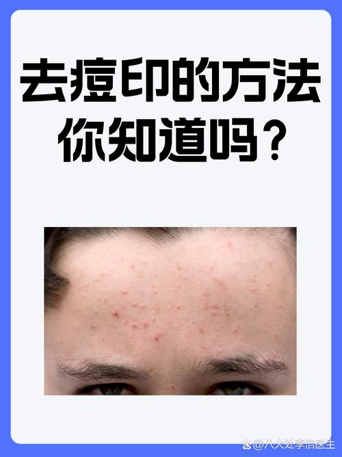 男士祛痘印什么方法最有效？-图2