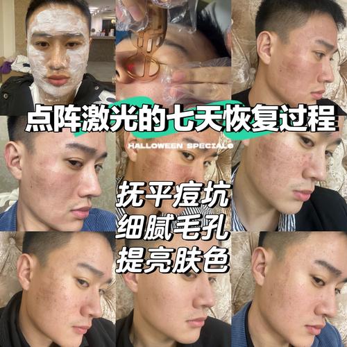 祛痘选蓝光还是激光？效果差异大吗？-图2