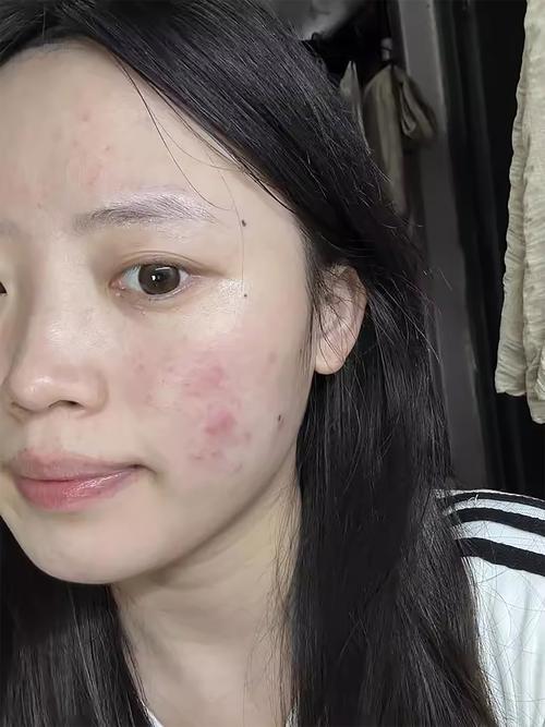 14岁女生祛痘绝招真的有效吗？-图3