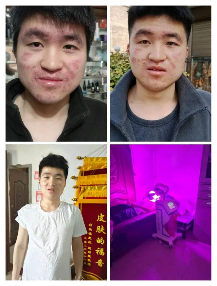红蓝光祛痘一个疗程需多久？-图2