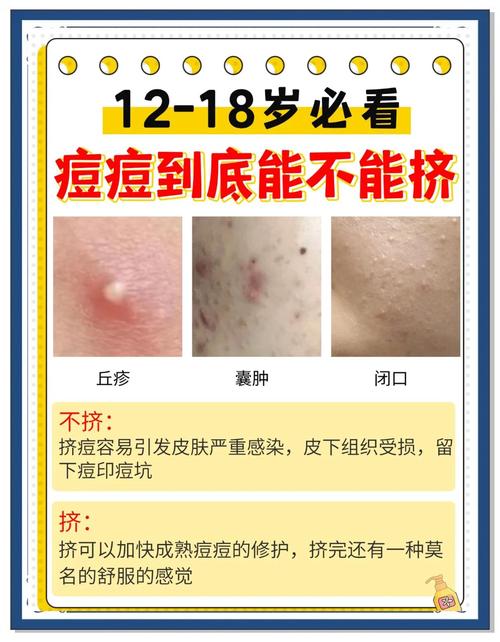 祛痘精华真能预防痘痘吗?-图3 祛痘精华真能预防痘痘吗?-图3