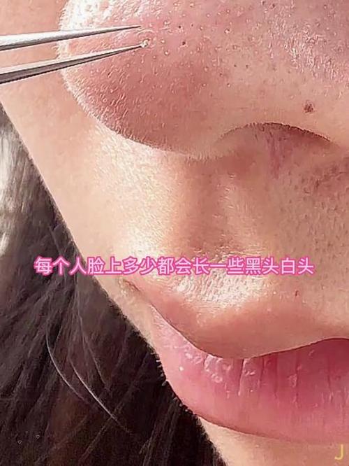 白头痘痘祛痘针真的最好用吗？-图1