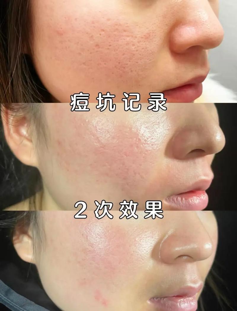 快速祛痘坑效果最好的方法是什么？-图2