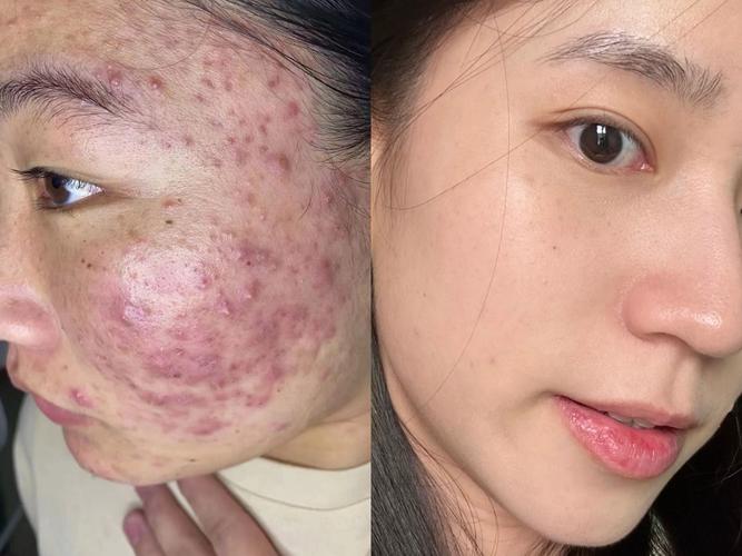 快速祛痘坑效果最好的方法是什么？-图1