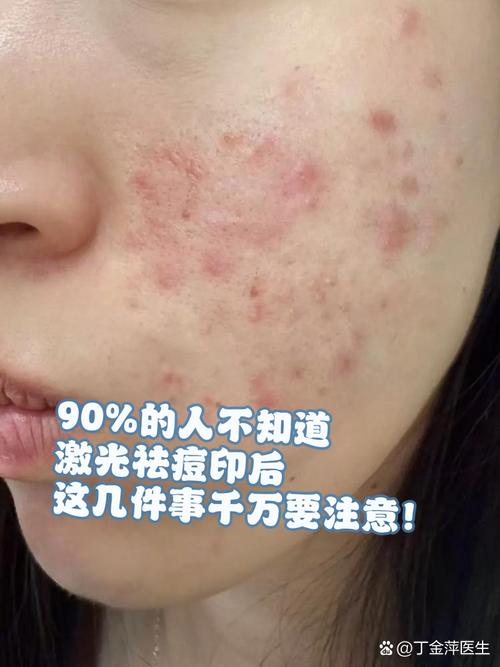 流产后能做激光祛痘吗-图3