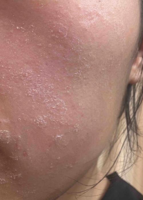 涂抹祛痘药膏全脸蜕皮-图1