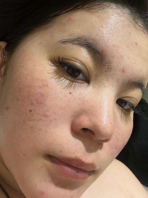 涂抹祛痘药膏全脸蜕皮-图3