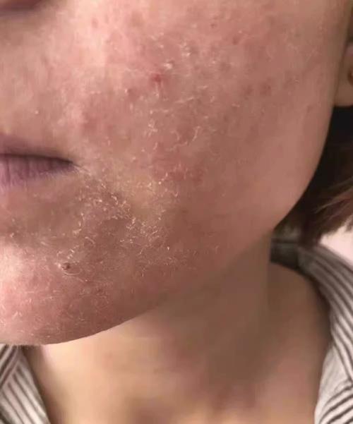 涂抹祛痘药膏全脸蜕皮-图2