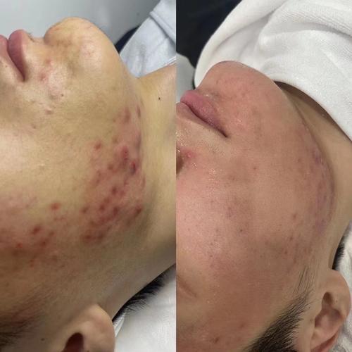 破皮后能用祛痘精油吗?-图2 破皮后能用祛痘精油吗?-图2