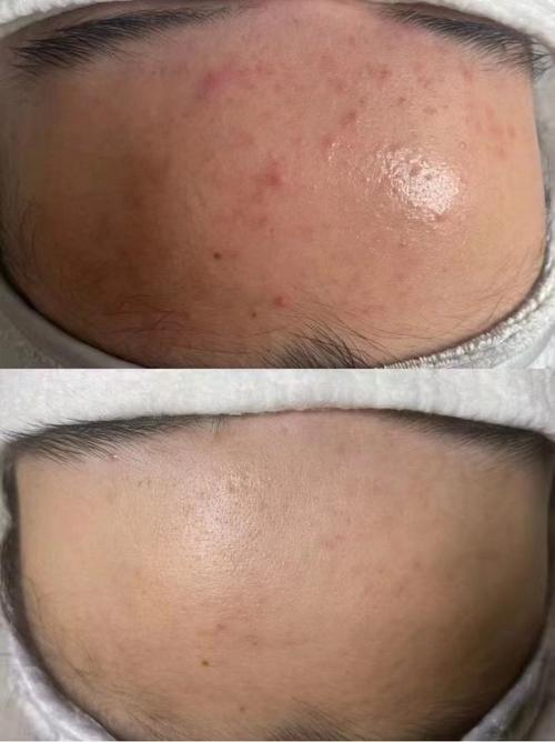 vc弄成粉加水祛痘印-图3