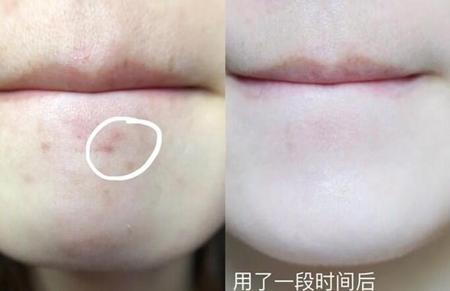土豆祛痘印的原理是什么？-图2