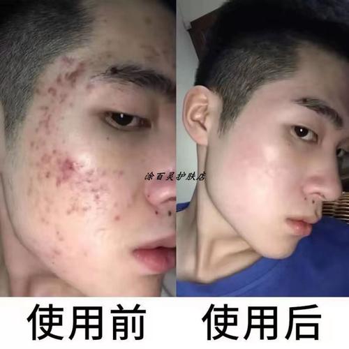 男士快速祛痘美白方法-图3