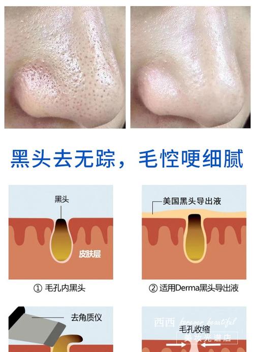 缩毛孔去黑头，护肤品真的能同时搞定吗？-图2
