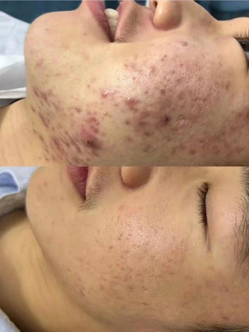 激光祛痘印效果最好的方法是什么?-图1 激光祛痘印效果最好的方法是什么?-图1