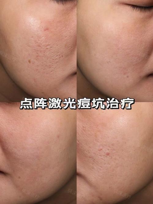 激光祛痘印效果最好的方法是什么?-图2 激光祛痘印效果最好的方法是什么?-图2