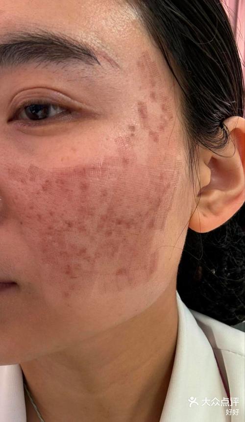 激光祛痘印效果最好的方法是什么?-图3 激光祛痘印效果最好的方法是什么?-图3