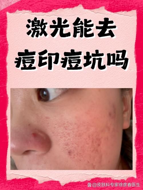 大蒜抹皮肤能祛痘吗?-图1 大蒜抹皮肤能祛痘吗?-图1