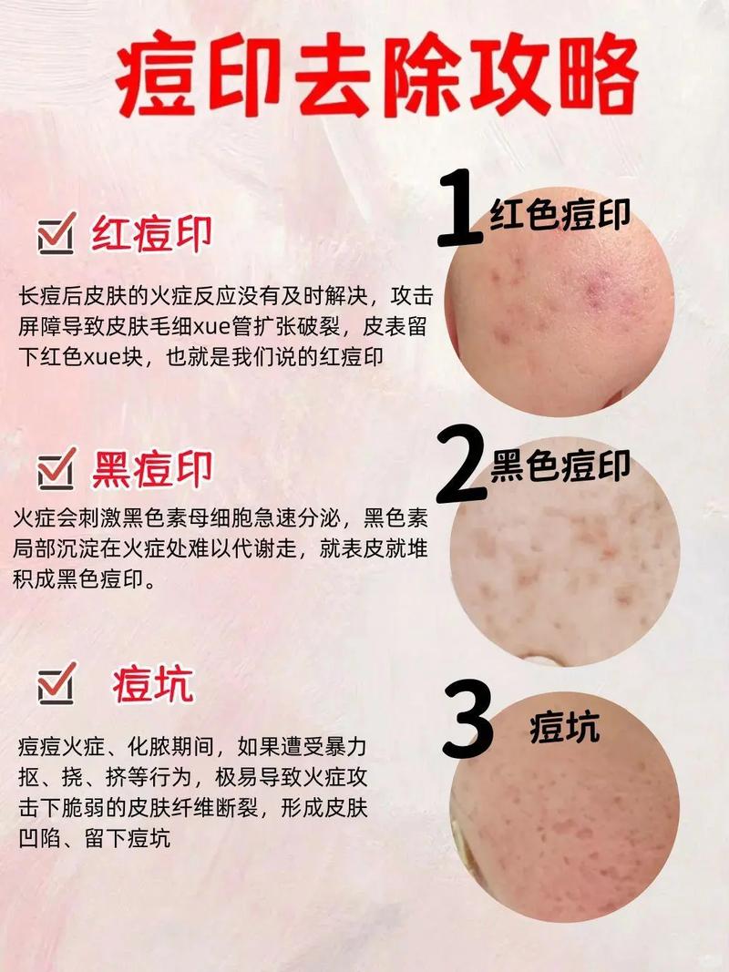 祛痘印偏方 有效果吗-图3 祛痘印偏方 有效果吗-图3
