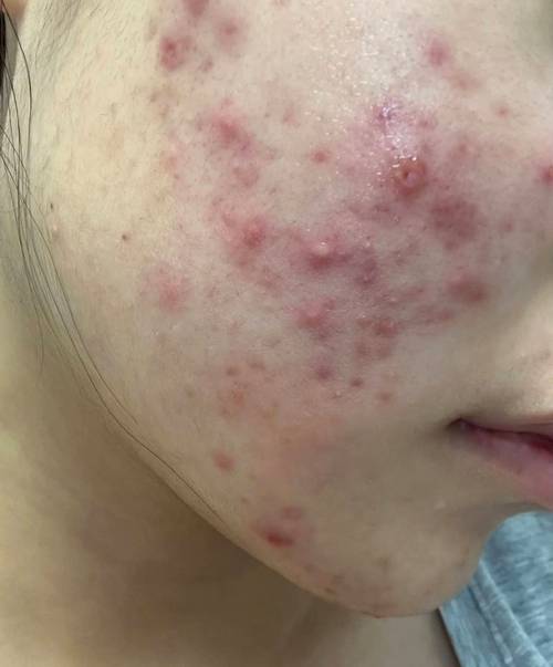 护肤品致痘？是产品问题还是肌肤排斥？-图1