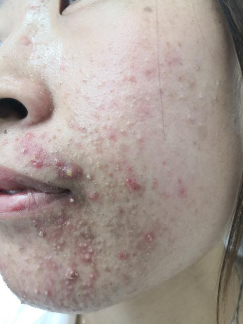 护肤品致痘？是产品问题还是肌肤排斥？-图2