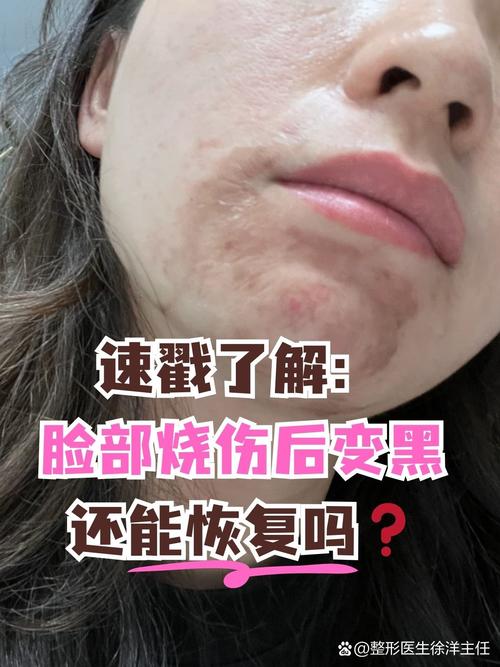 狮王祛痘会烧伤皮肤吗?-图2 狮王祛痘会烧伤皮肤吗?-图2