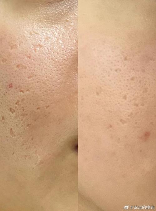 激光祛痘坑用的是什么激光？-图2