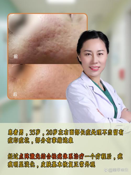 激光祛痘印危险吗?-图2 激光祛痘印危险吗?-图2