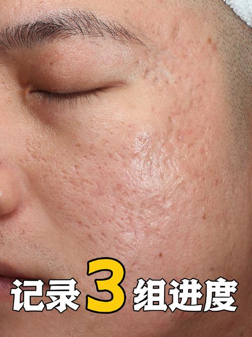 激光祛痘印危险吗?-图1 激光祛痘印危险吗?-图1