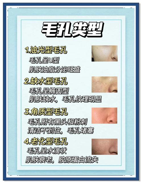 祛痘缩毛孔,有哪些科学方法?-图1 祛痘缩毛孔,有哪些科学方法?-图1