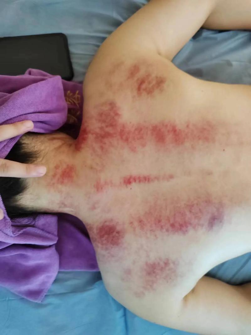 刮痧能祛痘吗?效果如何?-图1 刮痧能祛痘吗?效果如何?-图1