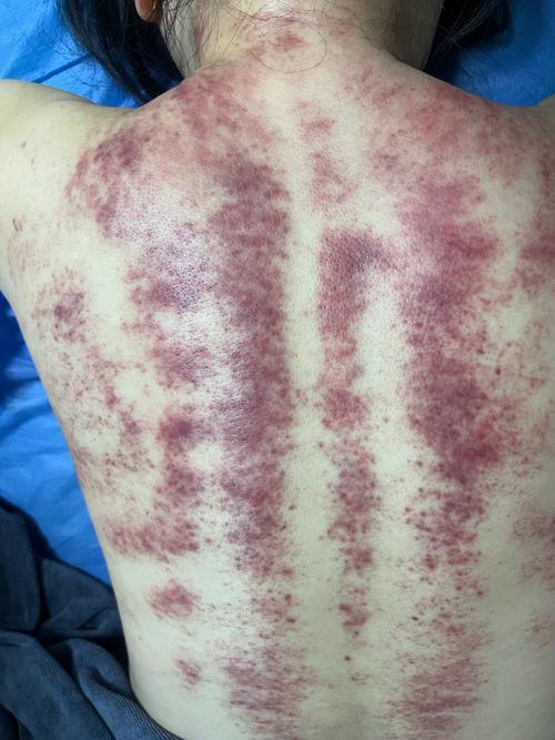 刮痧能祛痘吗?效果如何?-图2 刮痧能祛痘吗?效果如何?-图2