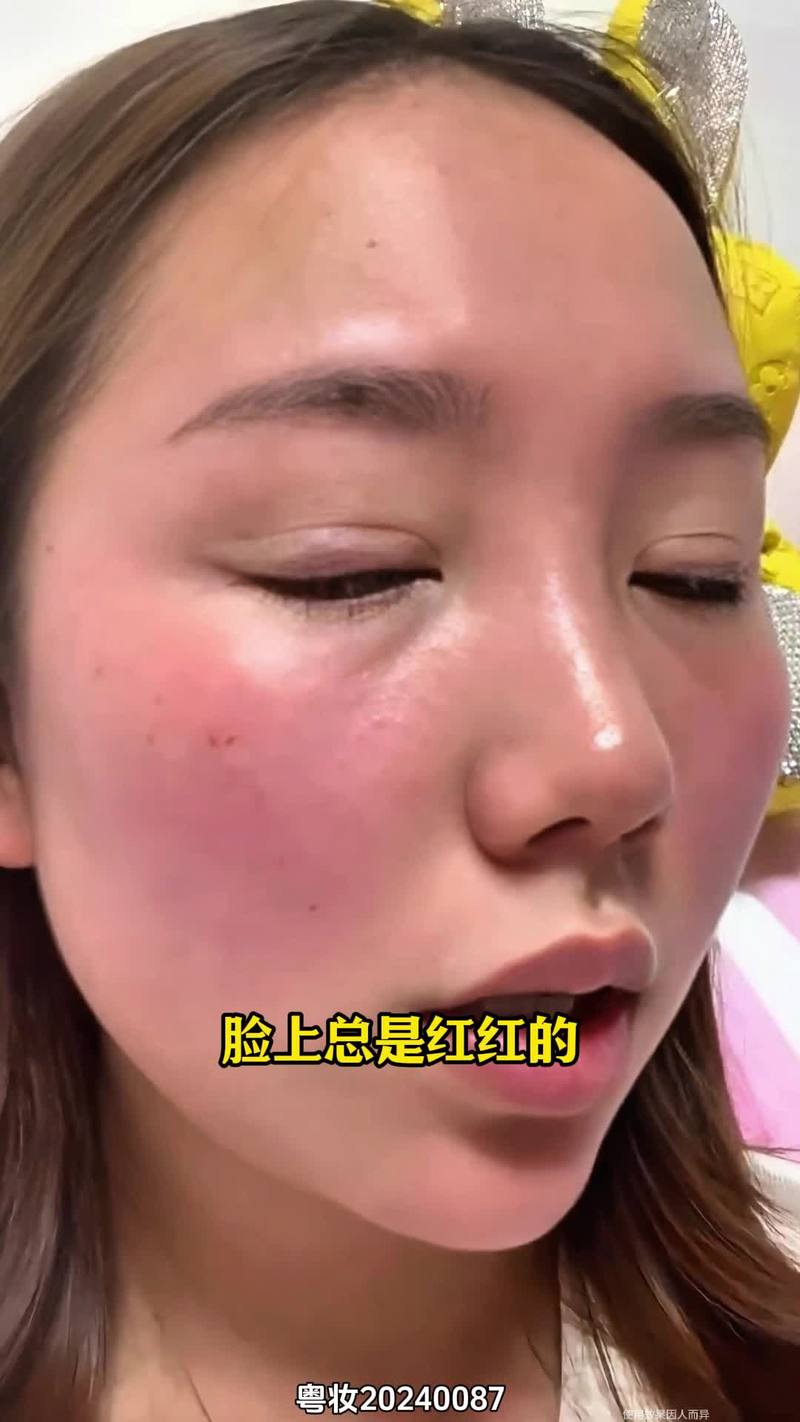 祛痘面膜敷后反长痘发红,为何?-图1 祛痘面膜敷后反长痘发红,为何?-图1