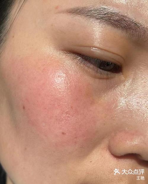 祛痘面膜敷后反长痘发红,为何?-图2 祛痘面膜敷后反长痘发红,为何?-图2