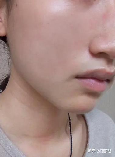 祛痘面膜敷后反长痘发红，为何？-图3