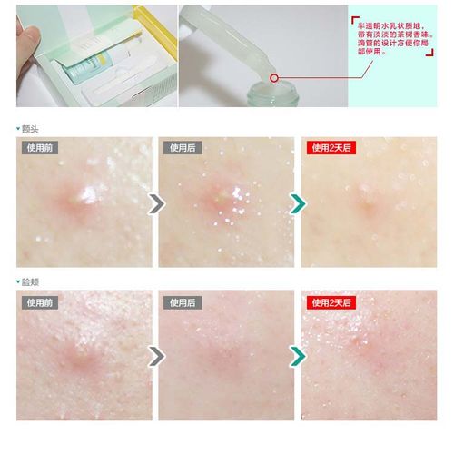 茶树祛痘印精华正确用法是什么?-图2 茶树祛痘印精华正确用法是什么?-图2
