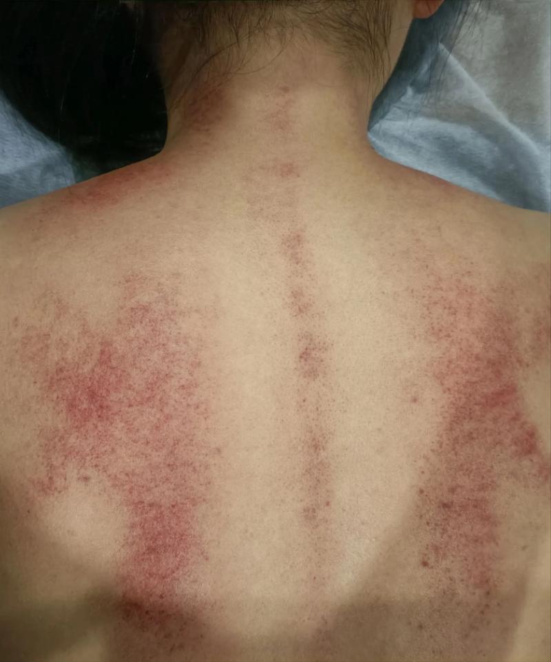 l刮痧真的可以祛痘吗-图2