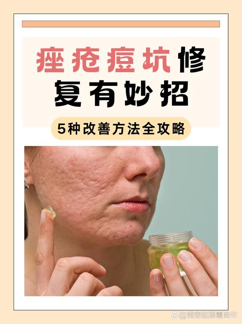 北京祛痘痕什么方法最有效?-图2 北京祛痘痕什么方法最有效?-图2