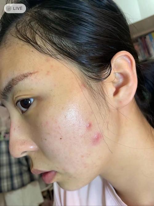 祛痘霜该用在面膜前还是后?-图2 祛痘霜该用在面膜前还是后?-图2