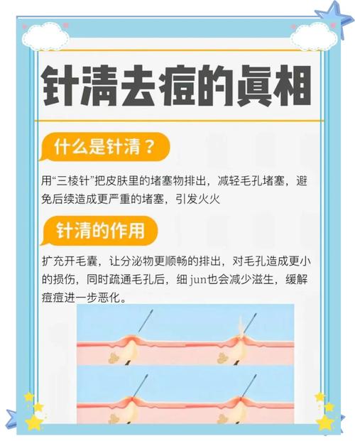 有没有手术祛痘的方法-图3 有没有手术祛痘的方法-图3