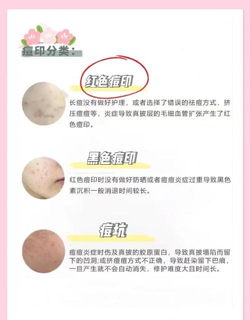祛痘印最快最好用的方法是什么?-图2 祛痘印最快最好用的方法是什么?-图2