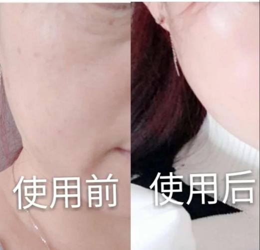 VC原液能祛痘印吗?效果如何?-图1 VC原液能祛痘印吗?效果如何?-图1