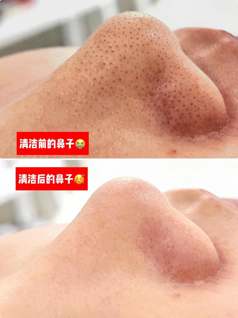 祛痘去黑头，哪个产品更有效？-图1