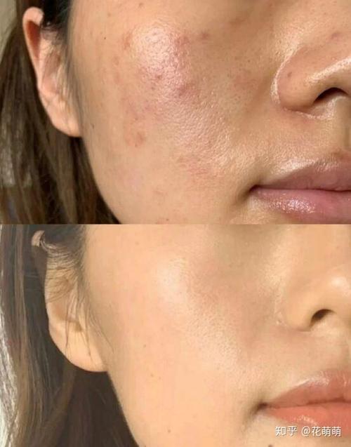 跑步能祛痘印吗?-图2 跑步能祛痘印吗?-图2