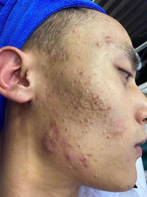 男士油痘肌如何快速消脓包？-图2