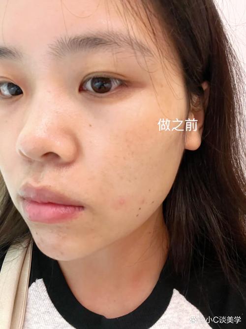 VE戳破能祛痘吗？-图2