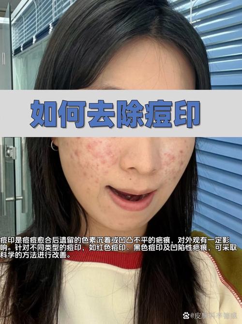 VE戳破能祛痘吗？-图3