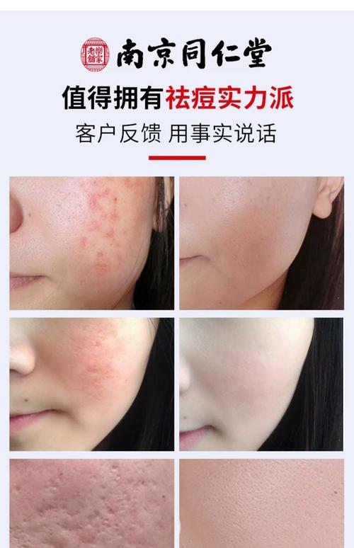 祛痘产品擦了痘痘真的会熟吗?-图1 祛痘产品擦了痘痘真的会熟吗?-图1