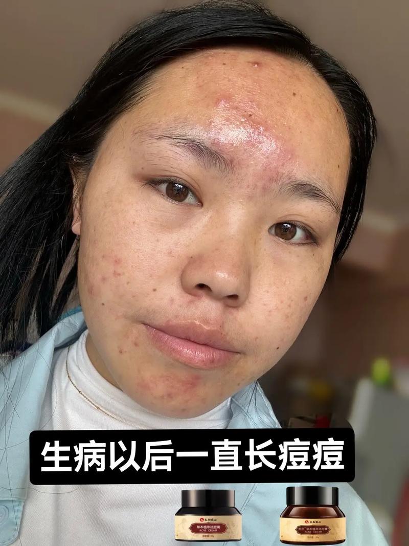 祛痘产品擦了痘痘真的会熟吗?-图2 祛痘产品擦了痘痘真的会熟吗?-图2