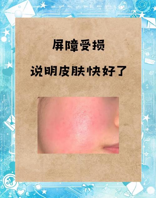 护肤品上脸刺痛，是缺水还是过敏？这几点你必须知道-图2