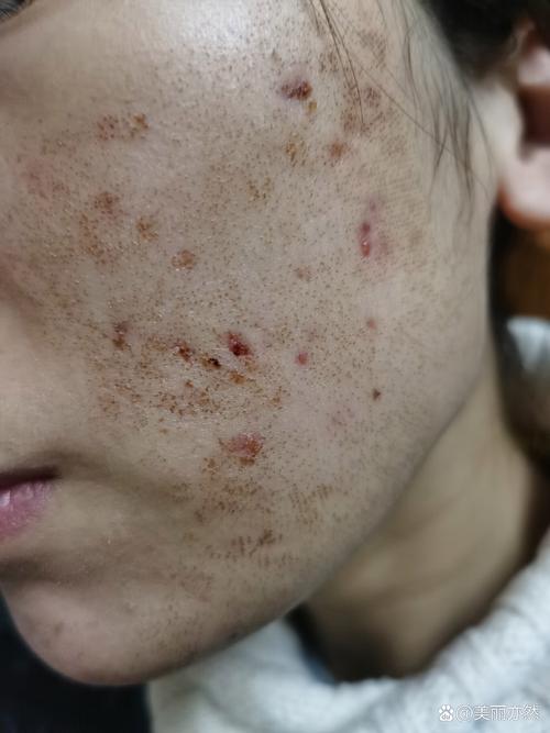 激光祛痘印后为何出现白点点？-图2